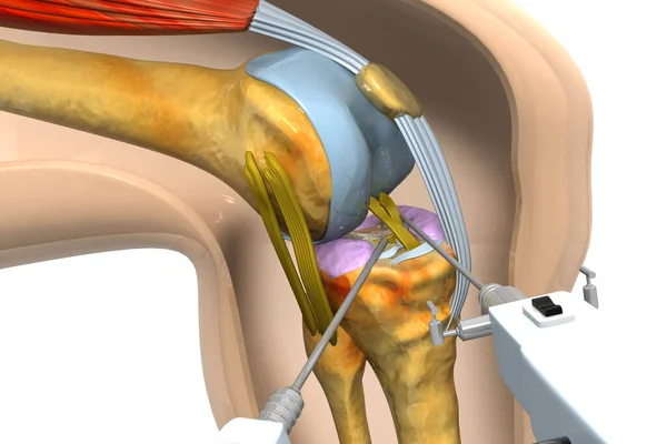 Human knee surgery 3d render