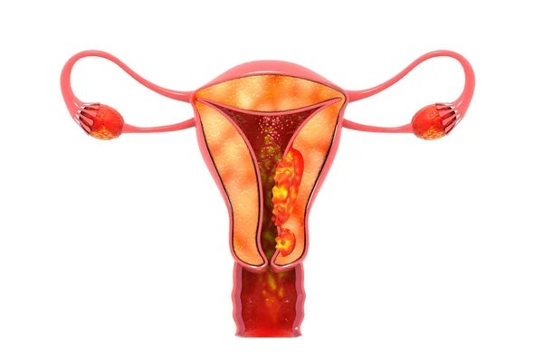 Cáncer Uterino Render — Foto de Stock