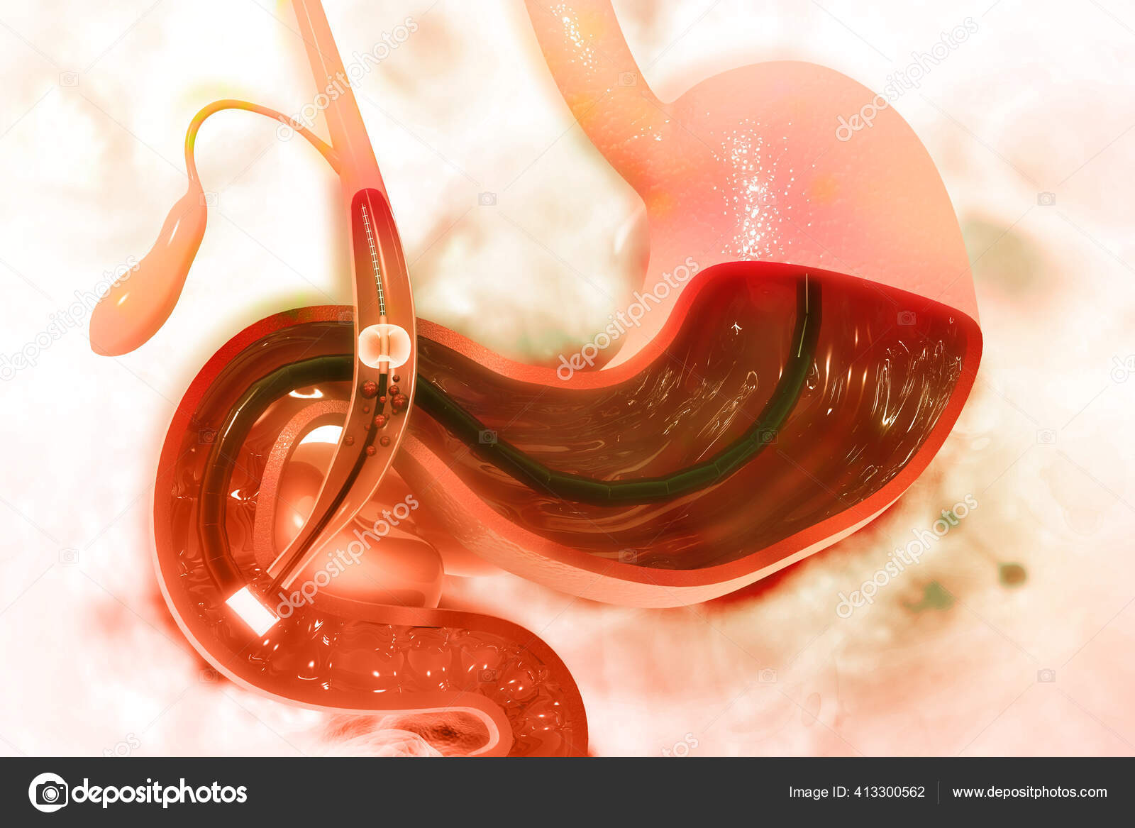 Stomach Endoscopy Bladder Stone Removal Illustration Stock Photo by