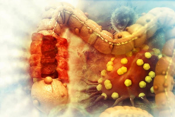 Colon Cancer Cancer Attacking Cell Colon Disease Concept Illustration — Stock Photo, Image