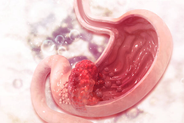 Stomach cancer. Cancer attacking cell. Stomach disease concept. 3d illustration