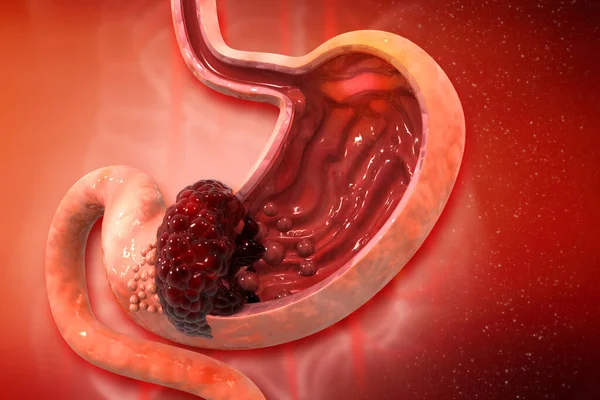 胃がん 癌が細胞を攻撃 胃疾患の概念 3Dイラスト — ストック写真