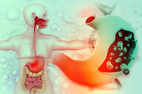 Stomach cancer. Cancer attacking cell. Stomach disease concept. 3d illustration