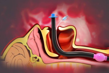 Bilimsel arka planda endotrakeal entübasyon