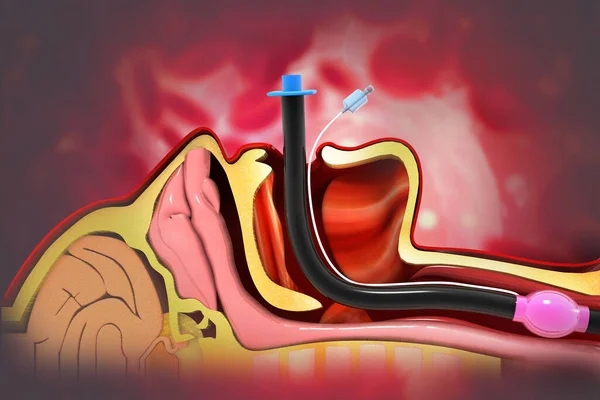 Intubação Endotraqueal Com Base Científica — Fotografia de Stock