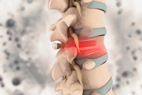 Spinal Column Implant Screw Placement Illustration — Stock Photo, Image