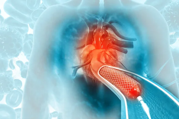 Angioplastia Del Stent Base Científica — Foto de Stock