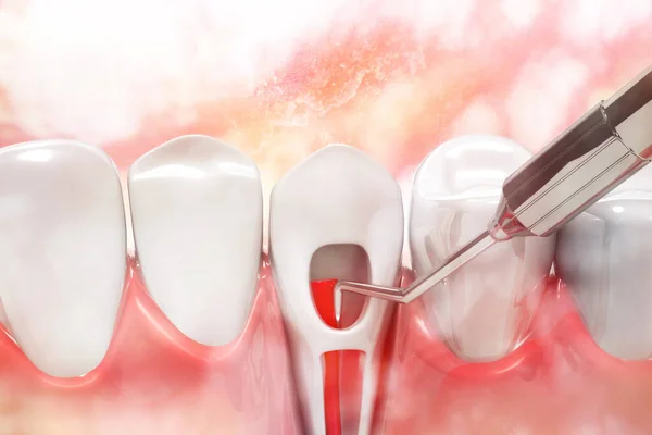 Proceso Tratamiento Del Canal Radicular — Foto de Stock