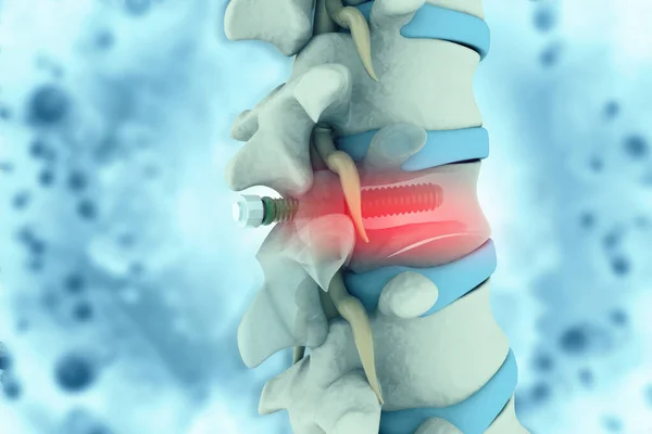 Spinal Column Implant Screw Placement — Stock Photo, Image