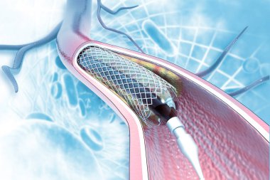 Bilimsel arka planda stent anjiyoplasti