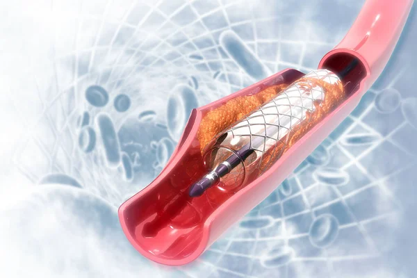 科学背景下的支架血管成形术 — 图库照片