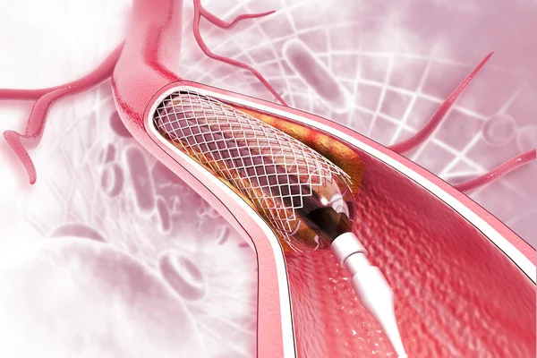 Stent Angioplasty Scientific Background — Stock Photo, Image