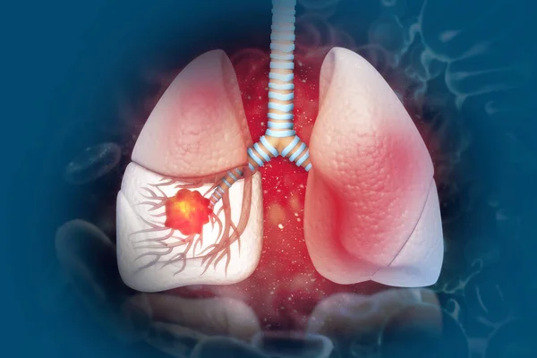 Cancer Poumon Maladie Pulmonaire Illustration — Photo