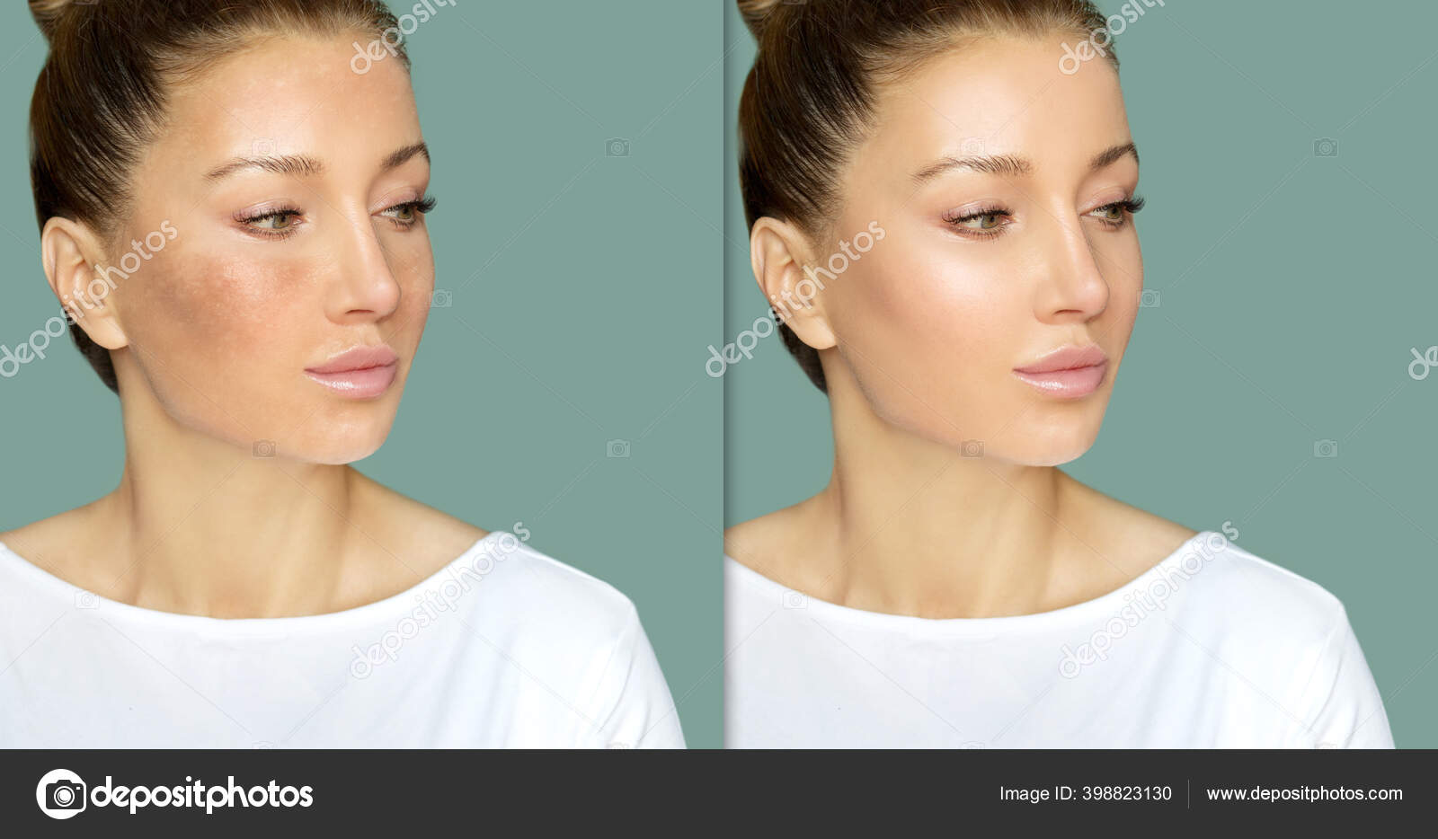 skin bleach for hyperpigmentation