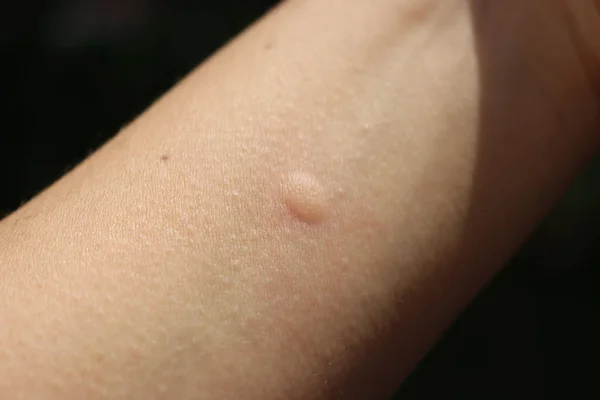 Szúnyogcsípés Egy Női Felnőtt Kéz Fekete Sötét Háttér — Stock Fotó