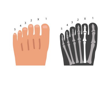 Ayak eksensel polidaktili. Birinci ve ikinci arasında fazladan parmak izi var. Vektör illüstrasyonu