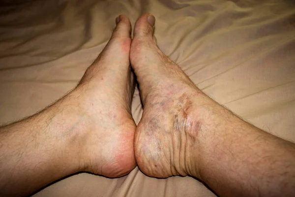 Damaged right foot of a 40 years old male which was severely damaged in car accident and healed over a years in comparison with normal left foot. Closeup shot