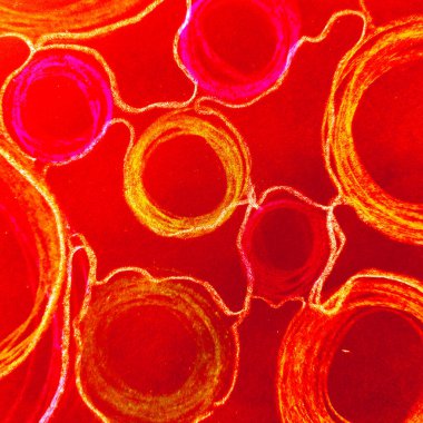 Kanser hücreleri şeffaf. Kırmızı Yuvarlak Sinirsel Boya. 