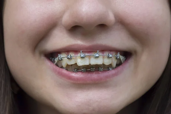 Girl Facial Skin Problems Metal Braces Her Teeth Stock Photo