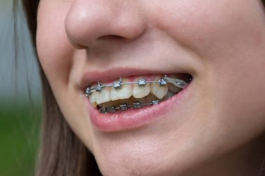 Dişlerinde metal diş teli olan gülümseyen kız.