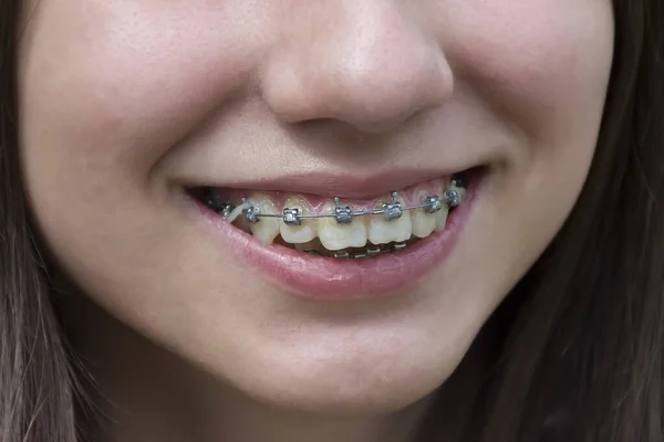 a girl with facial skin problems and metal braces on her teeth
