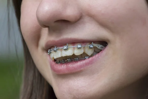 smiling girl with metal braces on her teeth