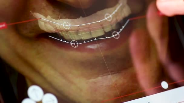 Tecnología Digital Sistema Cad Cam Dientes Antes Después Prótesis Sonriente — Vídeos de Stock