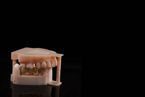 Implante Humano Dental Concepto Dental Dientes Humanos Cerámica Prótesis Dentales — Foto de Stock