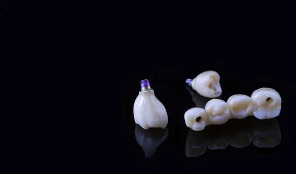 Implante Humano Dental Concepto Dental Dientes Humanos Cerámica Prótesis Dentales —  Fotos de Stock