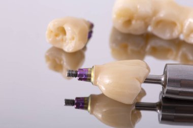 İnsan implant diş. Diş kavramı. Seramik insan diş ya da protez.