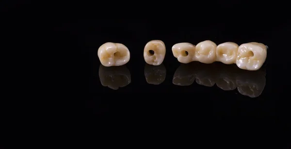 人間のインプラントを歯します 歯科のコンセプトです セラミックの歯や入れ歯 — ストック写真