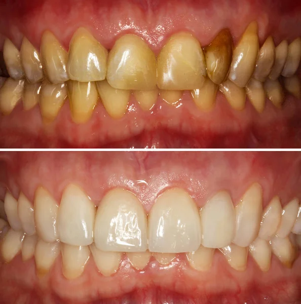 Przednie Zęby Przed Renowacji — Zdjęcie stockowe