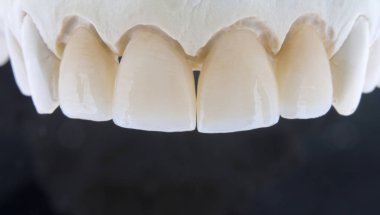Alçı model siyah bir arka plan ile seramik diş