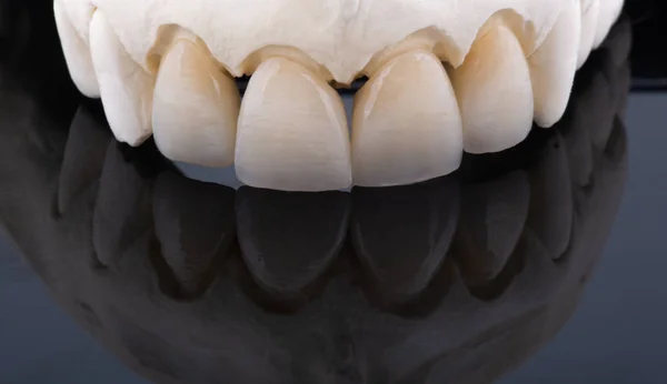 Dentes de cerâmica em um modelo de gesso com um fundo preto — Fotografia de Stock