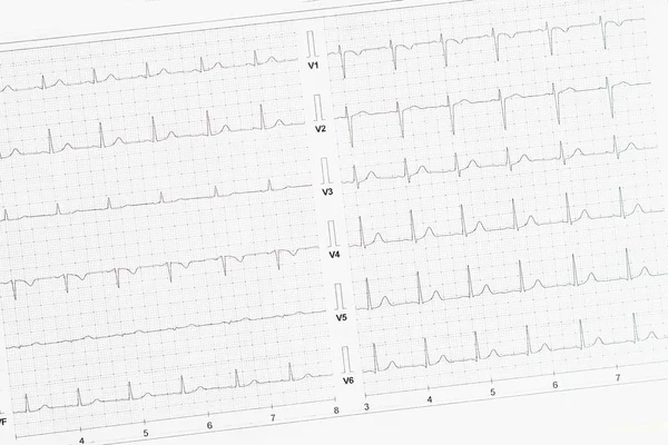 Elektrocardiogram Papier Als Medische Achtergrond — Stockfoto
