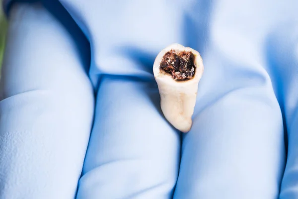 Extraherade Rotter Molar Isolerade Tandläkare Hand Med Blå Medicinsk Handske — Stockfoto