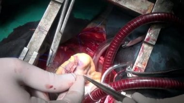 Hastanın kliniği canlı organ işlemi sırasında cerrahi iplik ile kalp.
