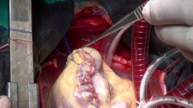 Hastanın kliniği işlemi sırasında canlı organ üzerinde cerrahi iplik ile kalp.