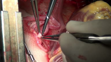 Hastanın kliniği işlemi sırasında canlı organ üzerinde cerrahi iplik ile kalp.