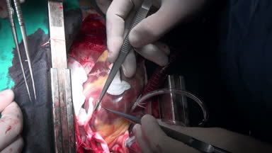 Canlı organ benzersiz makro operasyonunda kalp klinikte video kesme.