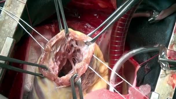 Wyciąć serce płaszczyzny przez profesjonalny lekarz chirurg unikalne macro wideo w klinice. — Wideo stockowe