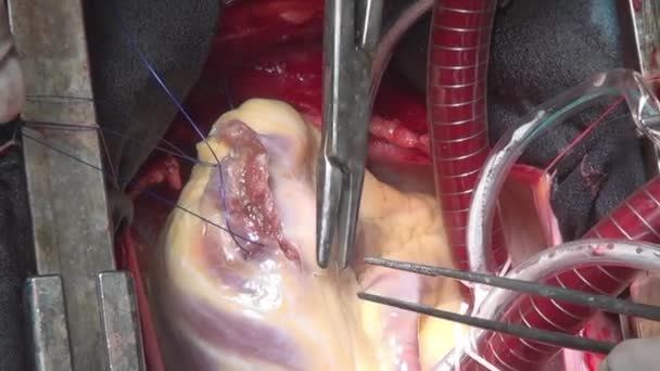 Chirurg näht Herz während Operation an lebendem Organ einer Person in Klinik auf. — Stockvideo