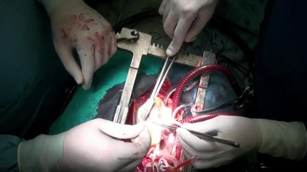 Surgeon sews up heart with atraumatic suture material during operation. — Stock Video