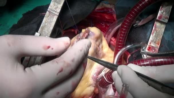 Heart with atraumatic suture material surgical thread during operation. — Stock Video
