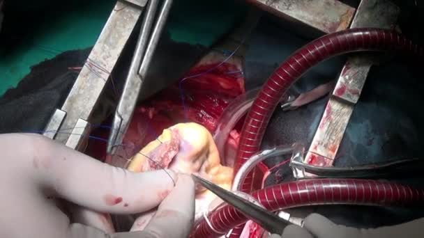 Heart with surgical thread during operation on live organ of patient in clinic. — Stock Video