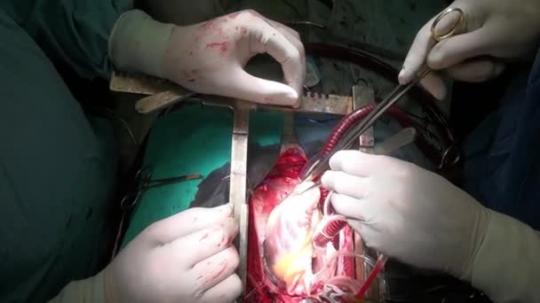 Heart with surgical thread during operation on live organ of patient in clinic. — Stock Video