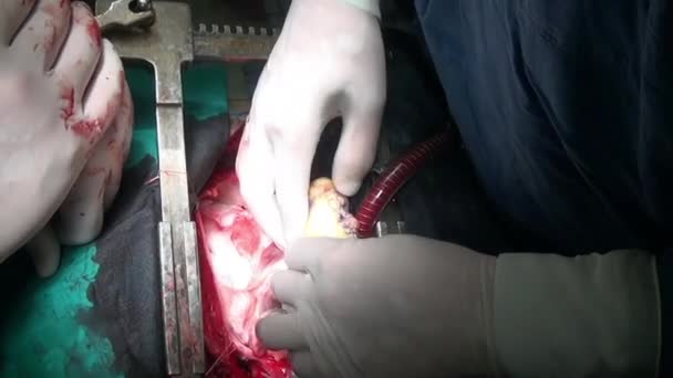 Heart surgery on live organ of patient in hospital. — Stock Video