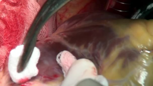 Hart chirurgie unieke macro video close-up in kliniek. — Stockvideo