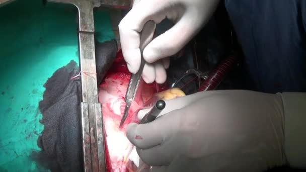 Chirurgie cardiaque sur organe vivant du patient à l'hôpital . — Video