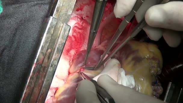 Hart chirurgie unieke macro video close-up in kliniek. — Stockvideo